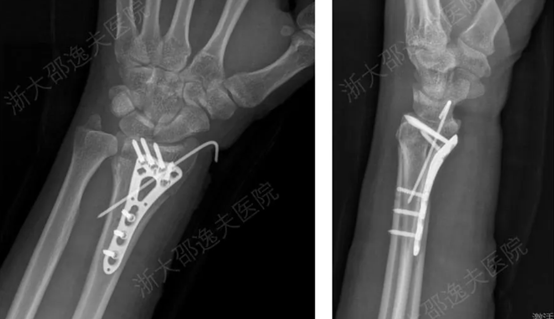 Các nhà khoa học Trung Quốc phát triển chất kết dính gắn xương gãy chỉ trong 3 phút - Techlade